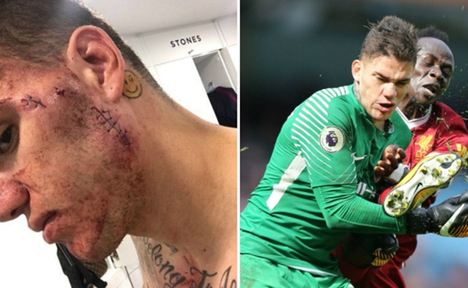 Fan Liverpool câm nín trước khuôn mặt biến dạng vì các mũi khâu của Ederson