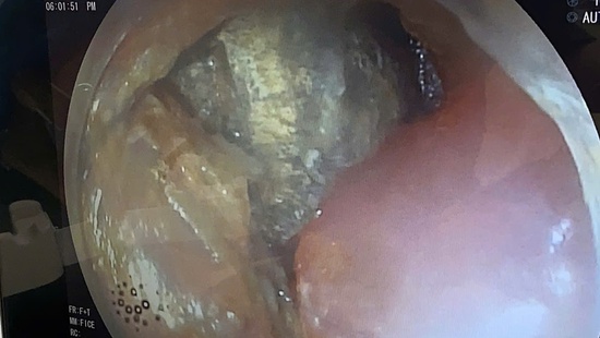 Cảnh báo nguy cơ từ pin cúc áo: Bé trai 2 tuổi suýt thủng thực quản