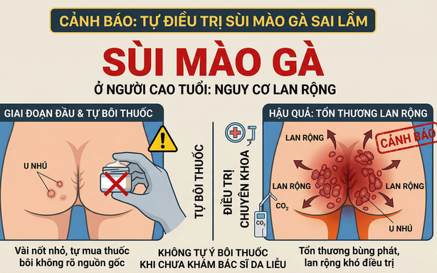 Sùi mào gà ở người cao tuổi: Xấu hổ tự điều trị hay đối mặt nguy cơ lan rộng khó lường?