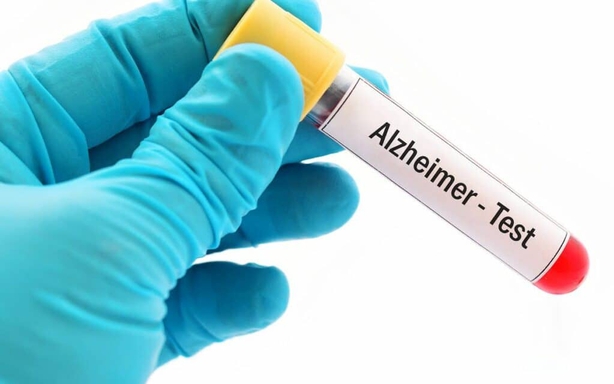 Bộ xét nghiệm máu mới giúp phát hiện sớm bệnh Alzheimer