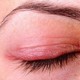 Viêm bờ mi - bệnh lý thường gặp, dễ tái phát