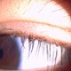 Phát hiện rận mi bám dày trên mi mắt bé gái 4 tuổi