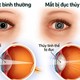 Mắt mờ ở người lớn tuổi - đừng vội nghĩ chỉ do tuổi tác