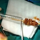 Thành công cứu bé gái bị que xiên thịt đâm xuyên nền sọ