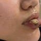 Nguy cơ hoại tử từ những mũi tiêm tan filler tại spa không được cấp phép
