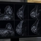 AI giúp tăng tốc chụp MRI phát hiện ung thư vú