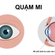 Quặm mi - khi lông mi âm thầm "cào xước" giác mạc mỗi ngày