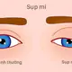 Bệnh lý sụp mi và những điều cần biết