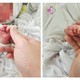Phẫu thuật cứu cẳng chân bé sơ sinh 12 giờ tuổi bị dải sợi ối thắt nghẹt